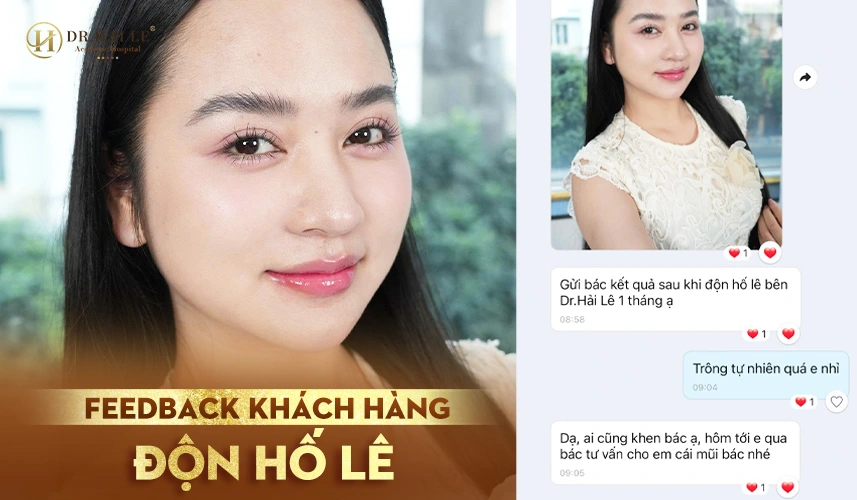 Thẩm mỹ độn hố lê – hoàn thiện đường viền cằm hài hòa