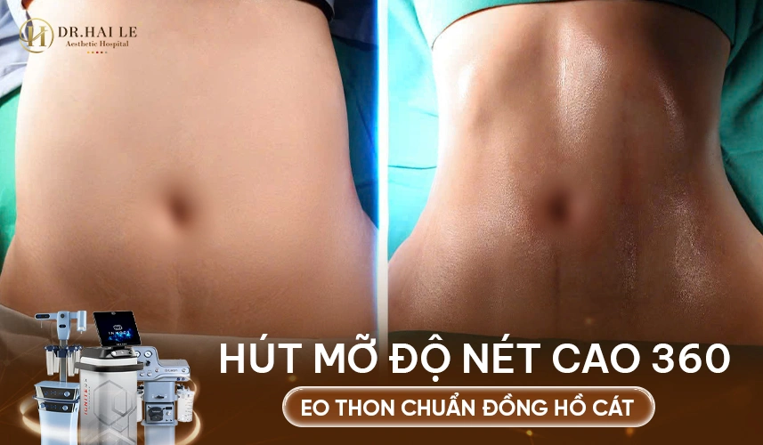 Hút mỡ eo tạo đường cong mềm mại, giúp vóc dáng thanh thoát và cân đối hơn.