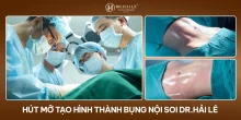Hút mỡ tạo hình thành bụng tái cấu trúc vùng bụng Dr.Hải Lê