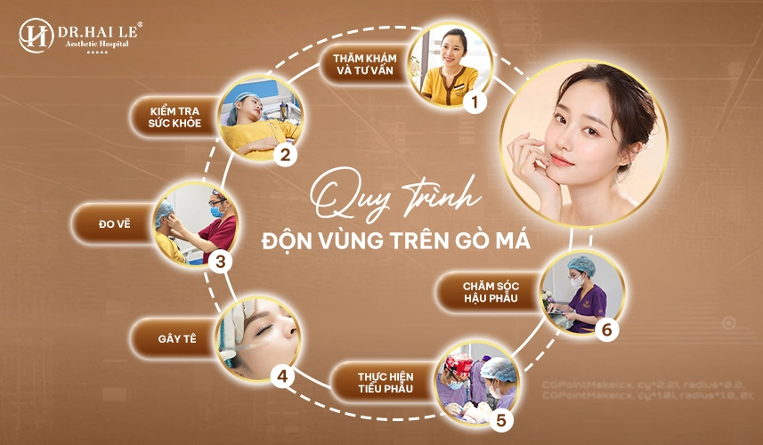 Kỹ thuật đặt sụn chính xác trên gò má, hạn chế lộ sụn và xô lệch