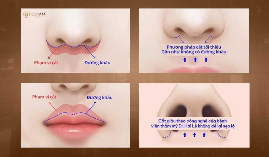 Tạo hình nhân trung chuẩn y khoa – an toàn – chính xác