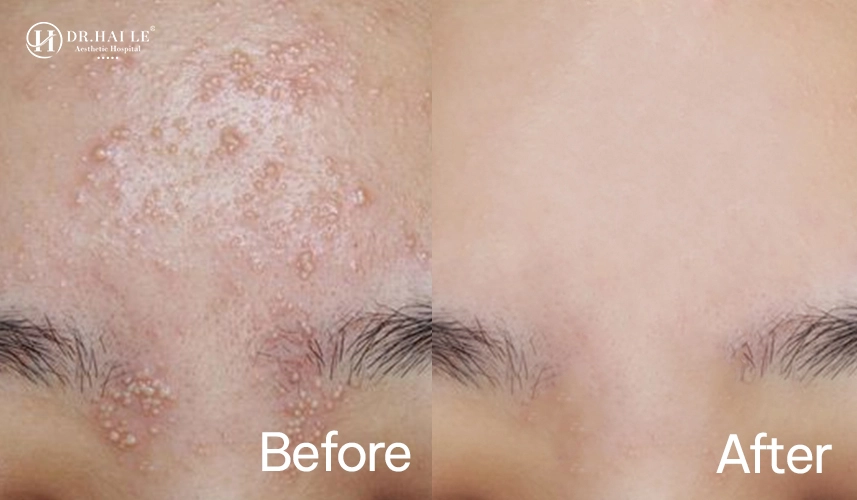 Xóa Mụn Thịt 3 Cận cảnh quy trình xóa mụn thịt bằng công nghệ laser hiện đại