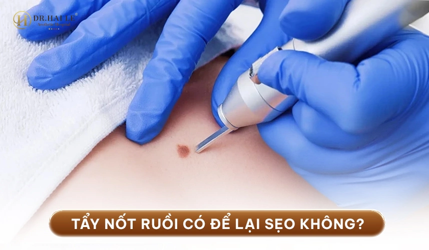 Xóa Nốt Ruồi 3 Xóa nốt ruồi bằng công nghệ laser hiện đại, kiểm soát độ sâu