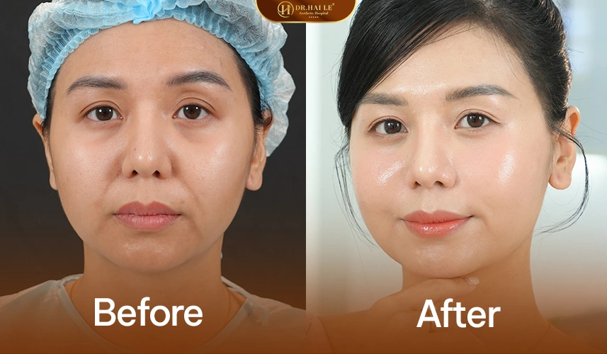 Thẩm mỹ độn hố lê không thay đổi gương mặt – chỉ làm gương mặt hài hòa hơn