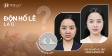Thẩm mỹ hố lê – hoàn thiện đường viền cằm hài hòa