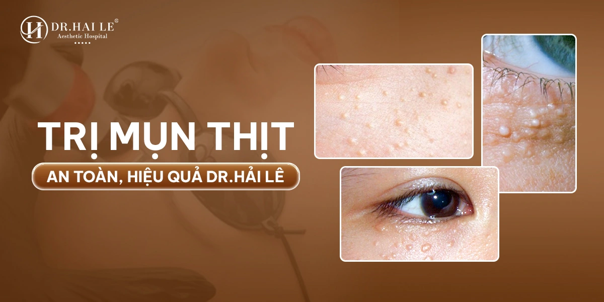 Xóa Mụn Thịt 1 Điều trị mụn thịt chuẩn y khoa, không đau – không sẹo – hồi phục nhanh