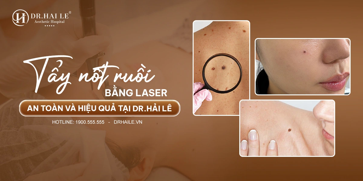 Xóa Nốt Ruồi 1 Giải pháp xóa nốt ruồi chuẩn y khoa cho làn da mịn màng