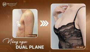 Nâng ngực Dual Plane giúp vòng 1 đầy đặn