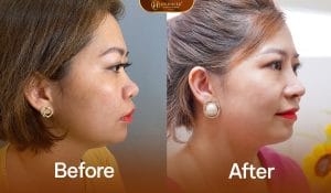 Nâng mũi demi 5d tại Dr.Hải Lê giúp trẻ hóa dáng mũi