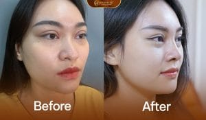 Nâng Mũi Cấu Trúc Sụn Sườn 7 Nâng mũi cấu trúc sụn sườn cân chỉnh phù hợp với khách hàng