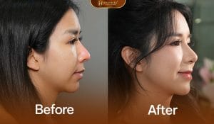 Nâng mũi trung bì ảnh trước sau khách hàng sau khi nâng