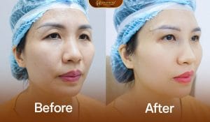 Cải thiện tầm nhìn sau khi nâng cung mày