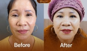 Sửa mí lỗi hỏng deep tech med tại Dr.Hải Lê