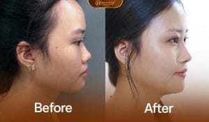 Nâng mũi demi 5d giúp dáng mũi cao bay hơn