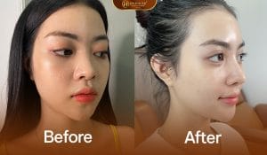Nâng Mũi Cấu Trúc Sụn Sườn 6 Nâng mũi cấu trúc sụn sườn mang lại nét hài hòa cho khuôn mặt