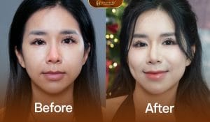 Nâng mui trung bì giúp cho dáng mũi có nét tự nhiên