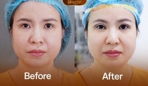 Trẻ hóa sau khi nâng cung mày tại Dr.Hải Lê