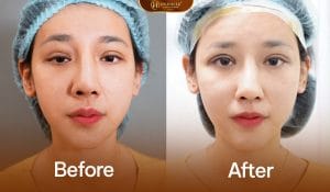 Sửa mí deep tech med tái tạo mí lỗi hỏng nặng