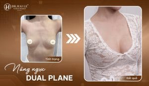 Nâng ngực Dual Plane định hình form ngực