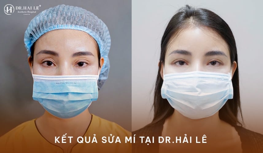 Kết quả thực tế sau khi sửa mí hỏng tại Dr.Hải Lê