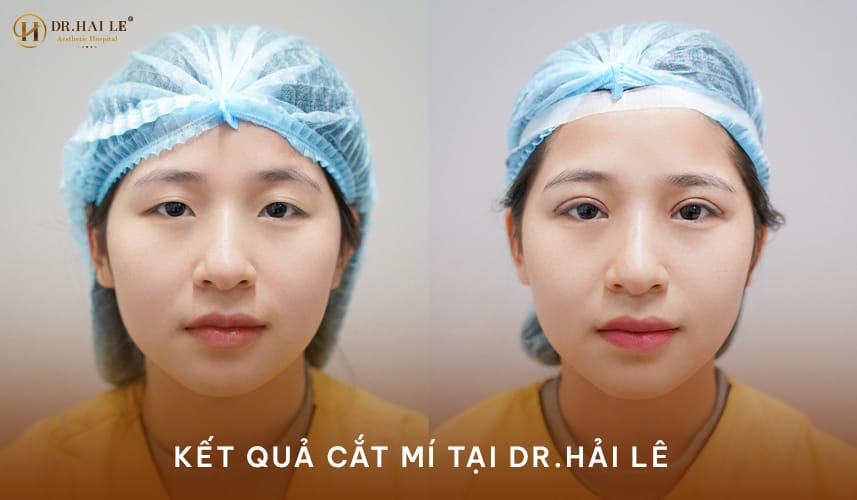 Kết quả cắt mí mắt tự nhiên chuẩn y khoa tại Dr.Hải Lê