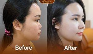 B-A khách hàng sau khi nâng mũi demi 5d tại Dr.Hải Lê