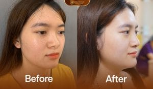 Nâng Mũi Cấu Trúc Sụn Sườn 5 Nâng mũi cấu trúc sụn sườn dáng mũi đẹp các góc cạnh