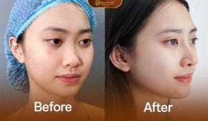 Nâng Mũi Cấu Trúc Medi-Form 6 Nâng mũi cấu trúc medi form mang nét đẹo toàn diện dáng mũi