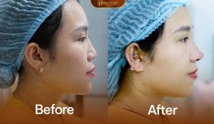 Nâng mũi trung bì giúp dáng mũi được nâng tự nhiên