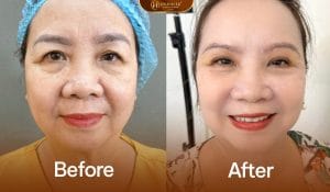 Nâng cung mày giúp trẻ trung vùng mắt