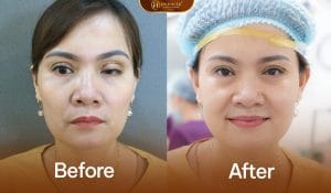 Sửa mí deep tech med giúp khắc phục mí lỗi nặng