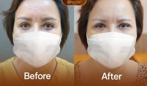 Sửa mí dưới lỗi hỏng cho khách hàng gặp tình trạng mí dưới lỗi