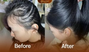 Ảnh trước sau cải thiện tình trạng tóc thưa
