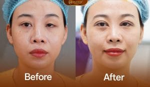 Ảnh trước sau khách hàng gặp tình trạng sụp mí không đều