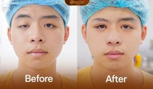 Ảnh trước sau khách hàng bị sụp mí nhược cơ nâng mí
