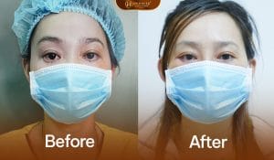 Khắc phục tình trạng mí dưới lỗi cho khách hàng