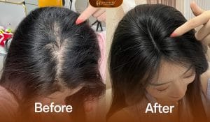 Ảnh trước sau điều trị rụng tóc từng vùng hiệu quả