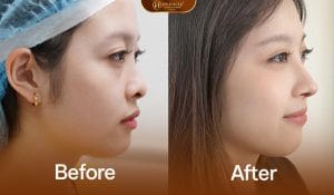 Nâng Mũi Cấu Trúc Medi-Form 7 Nâng mũi cấu trúc medi form giúp dáng mũi cao đẹp bền vững