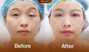 Ảnh trước sau khách hàng gặp tình trạng sụp mí một bên
