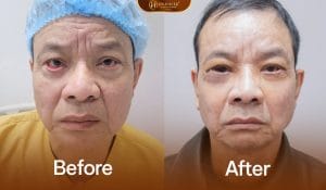 Sửa mí dưới cho khách hàng gặp tình trạng mí bị lật