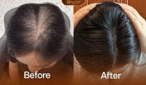 Ảnh trước sau cải thiện tình trạng rụng tóc sau sinh hiệu quả