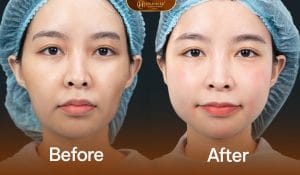 Khách hàng mặt hóp sau khi làm dịch vụ cân chỉnh full face rba