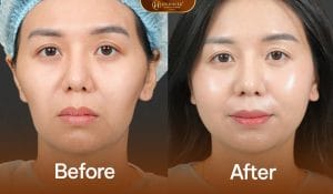Cân chỉnh full face rba giúp gương mặt được đầy đặn