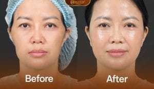 Ảnh trước sau khách hàng cân chinh full face rba