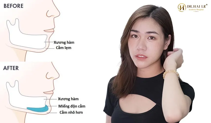 Độn cằm V-line là phương pháp phẫu thuật thẩm mỹ tạo hình tầng dưới mặt nhằm can thiệp kéo dài và điều chỉnh độ nhô của vùng cằm