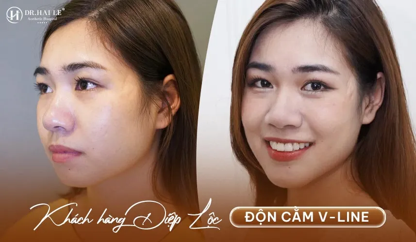 Minh chứng rõ ràng nhất cho hiệu quả vượt trội của phẫu thuật độn cằm V-line chuẩn y khoa tại Dr.Hải Lê