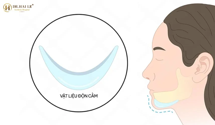 Bệnh viện Tạo hình Thẩm mỹ Dr.Hải Lê cam kết áp dụng những kỹ thuật độn cằm V-line tiên tiến nhất trong môi trường vô trùng tuyệt đối