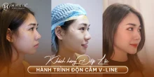 Hành trình độn cằm V-line thăng hạng nhan sắc của Diệp Lộc