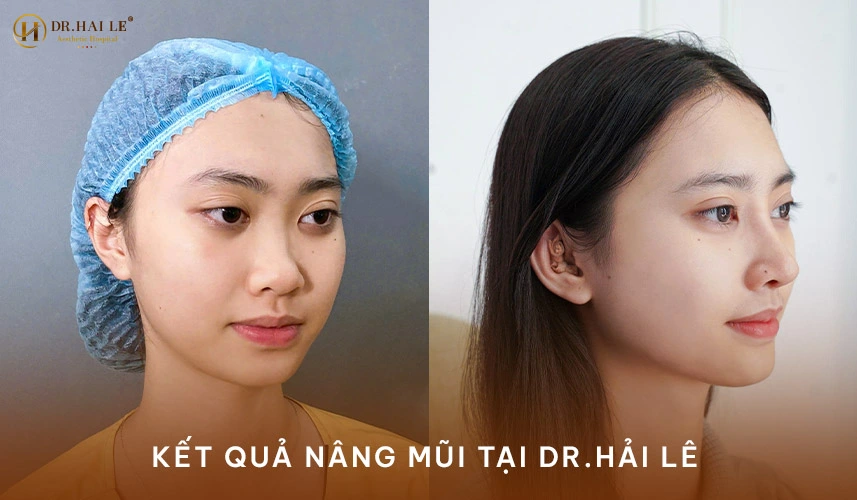 Kết quả khách hàng sau khi nâng mũi tại bệnh viện tạo hình thẩm mỹ Dr.Hải Lê 