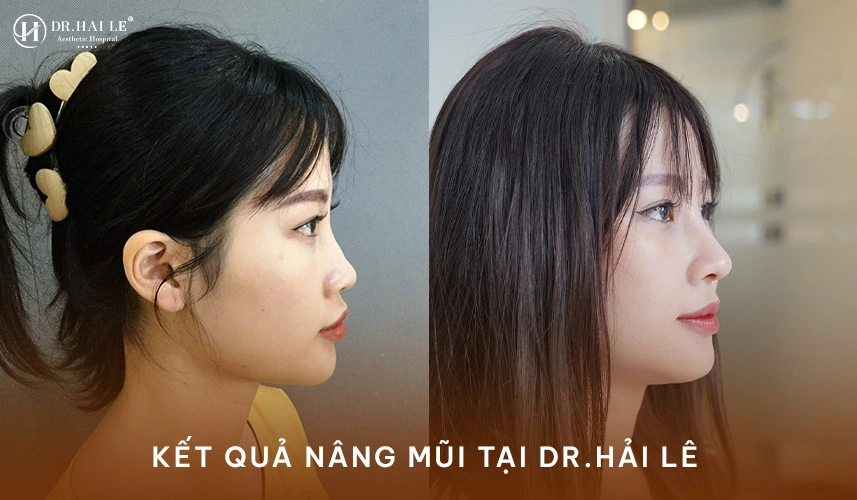 Kết quả dáng mũi khách hàng nâng mũi tại bệnh viện tạo hình thẩm mỹ Dr.Hải Lê